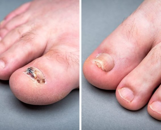 rekonstrukcja-paznokci