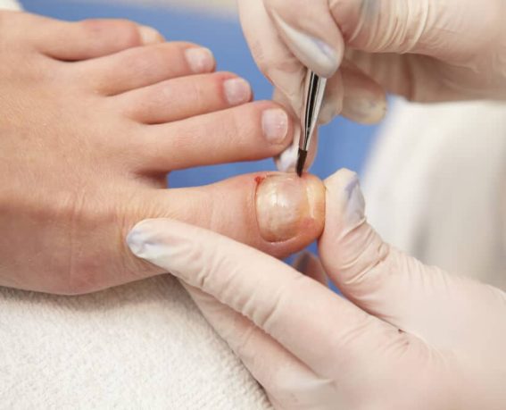 rekonstrukcja-paznokcia